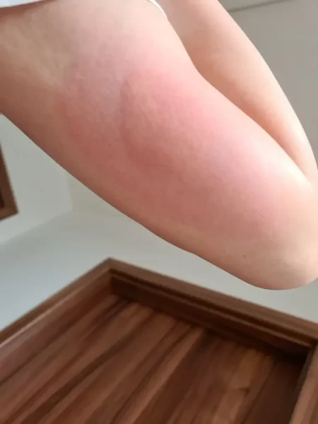 otok po píchnutí vosou